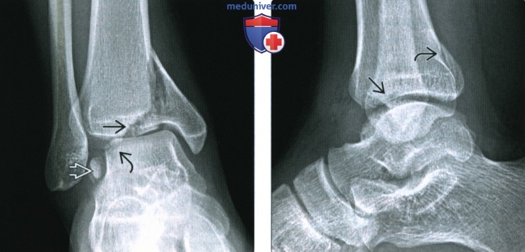 Рентгенограмма, КТ при вывихе голеностопного сустава