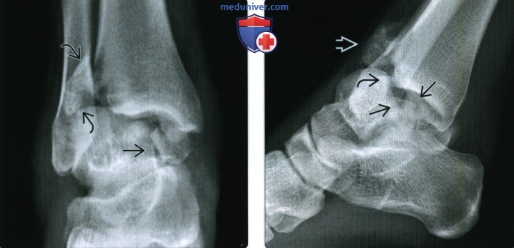 Рентгенограмма, КТ при вывихе голеностопного сустава