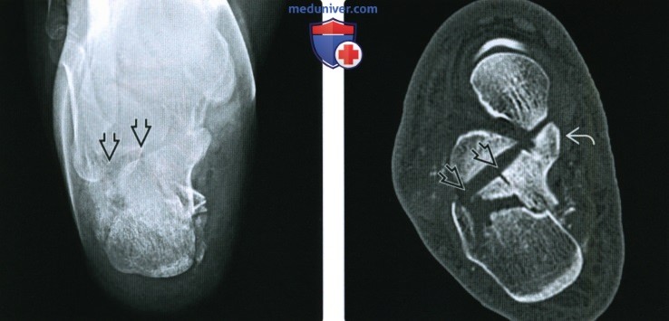 Рентгенограмма, КТ при внутрисуставном переломе пяточной кости
