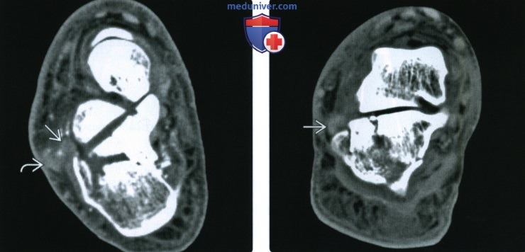 Рентгенограмма, КТ при внутрисуставном переломе пяточной кости