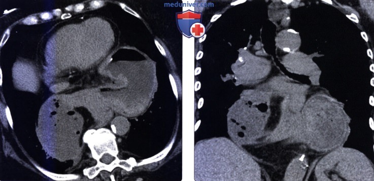 Рентгенография, КТ при завороте желудка