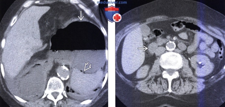Рентгенография, КТ при завороте желудка