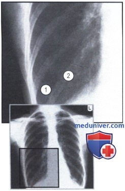 Рентгенограмма с увеличенными светлыми легкими при ХОБЛ