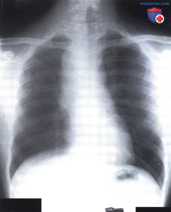 Рентгеновский снимок с затемнением в области средостения справа при лимфоме