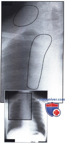 Рентгеновский снимок с затемнением в области средостения справа при лимфоме