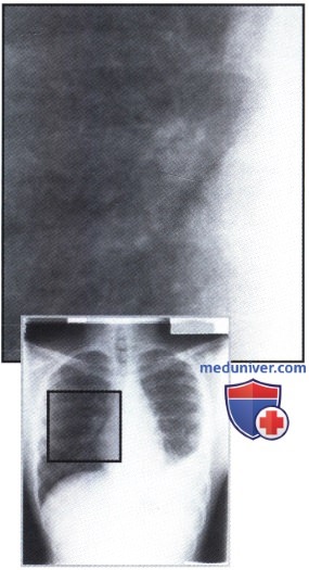 Рентгеновский снимок с множественными мелкими очаговыми тенями в обоих легочных полях