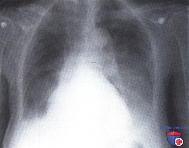 Рентгенограмма с затемнением в обоих легочных полях при миеломной болезни