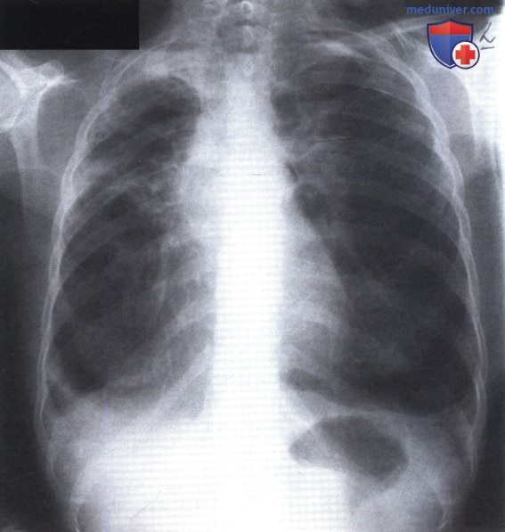 Рентгенограмма с затемнением в области верхушек легких при нетуберкулезной микобактериальной инфекции