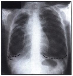 Рентгенограмма с затемнением в области верхушек легких при нетуберкулезной микобактериальной инфекции