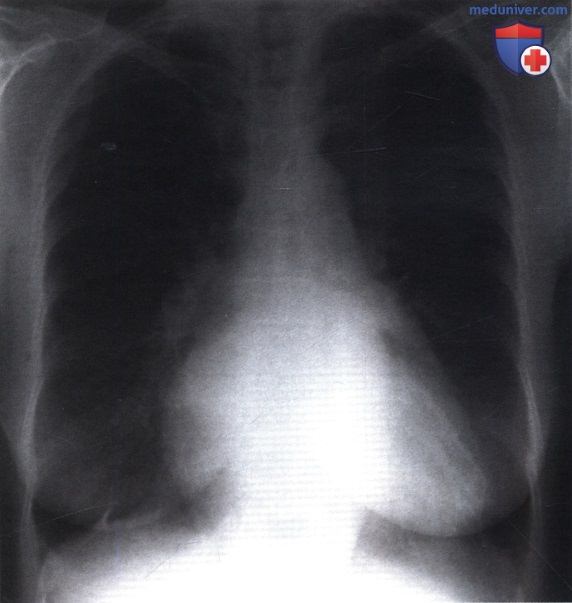 Рентгенограмма с патологической тенью сердца при митральном стенозе