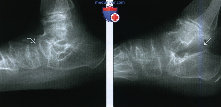 Рентгенограмма при множественной эпифизарной дисплазии
