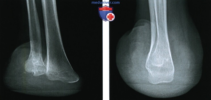 Рентгенограмма, МРТ после ампутации стопы