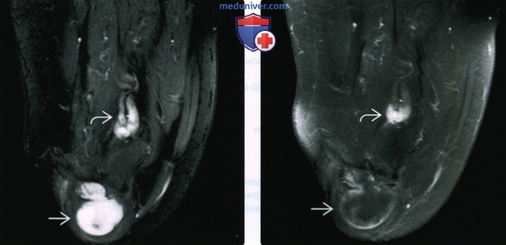 Рентгенограмма, МРТ после ампутации стопы