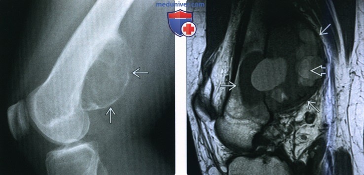 Рентгенограмма, МРТ при аневризмальной костной кисте