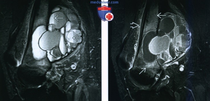 Рентгенограмма, МРТ при аневризмальной костной кисте