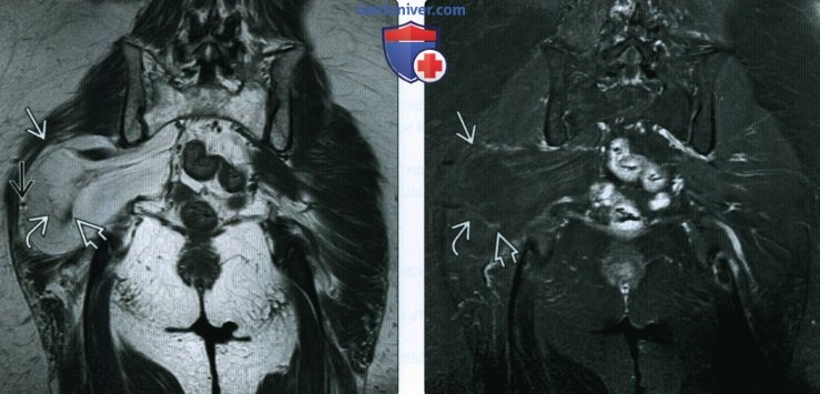 Рентгенограмма, МРТ при атипической липоматозной опухоли