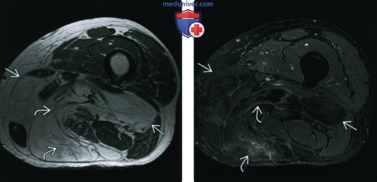 Рентгенограмма, МРТ при атипической липоматозной опухоли