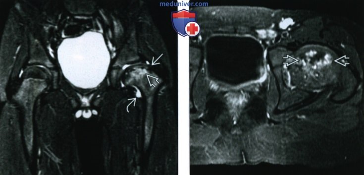 Рентгенограмма, МРТ при болезни Легга-Кальве-Пертеса