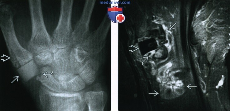 Рентгенограмма, МРТ при эндопротезе, артродезе мелких суставов кисти и стопы