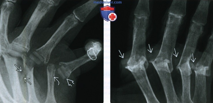 Рентгенограмма, МРТ при эндопротезе, артродезе мелких суставов кисти и стопы