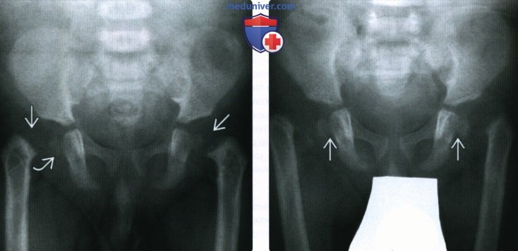 Рентгенограмма, МРТ при эпифизеолизе головки бедренной кости
