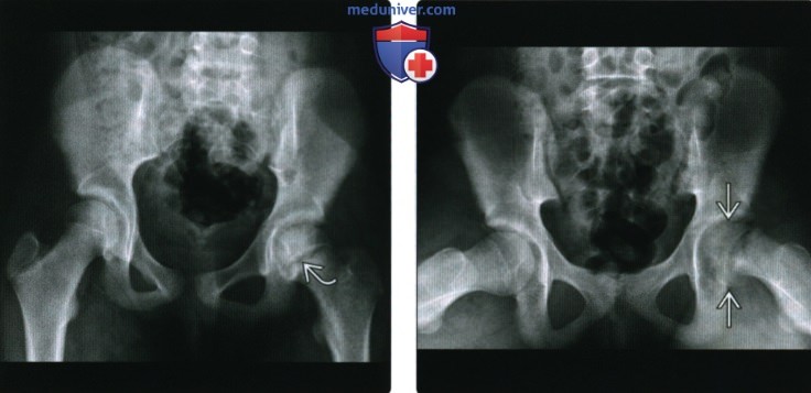 Рентгенограмма, МРТ при эпифизеолизе головки бедренной кости