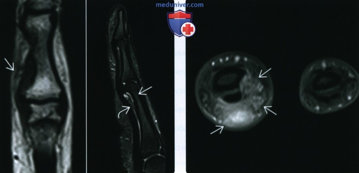 Рентгенограмма, МРТ при фиброме сухожильных влагалищ