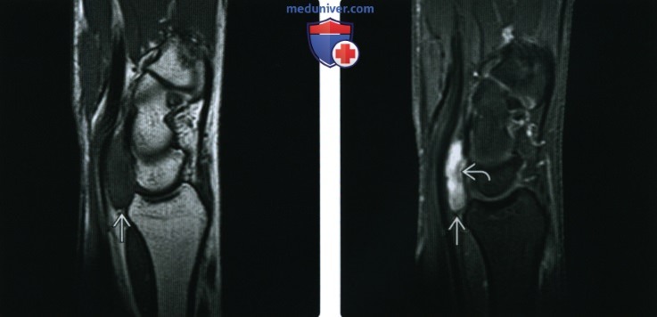 Рентгенограмма, МРТ при фиброме сухожильных влагалищ