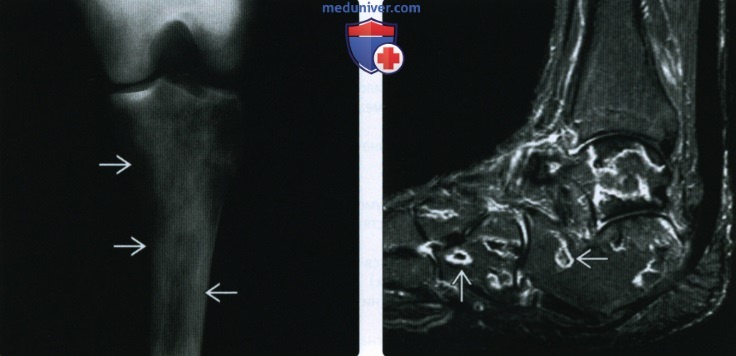 Рентгенограмма, МРТ при инфаркте кости