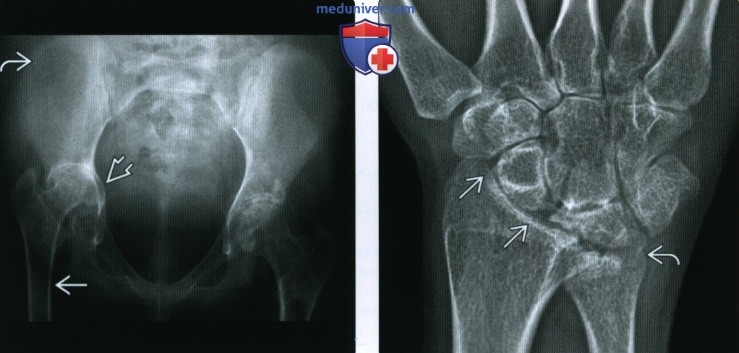 Рентгенограмма, МРТ при ювенильном идиопатическом артрите