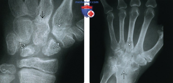 Рентгенограмма, МРТ при ювенильном идиопатическом артрите