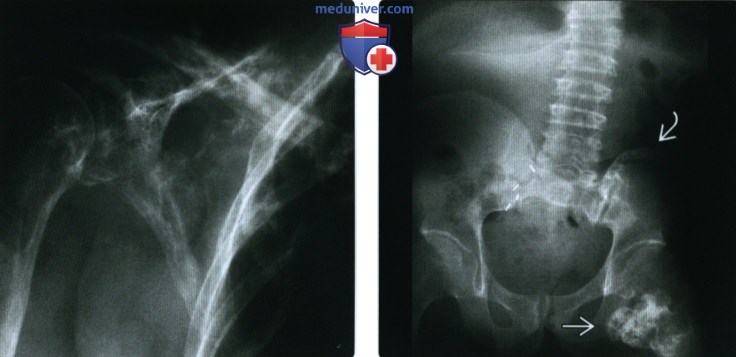Рентгенограмма, МРТ изменений костей после лучевой терапии
