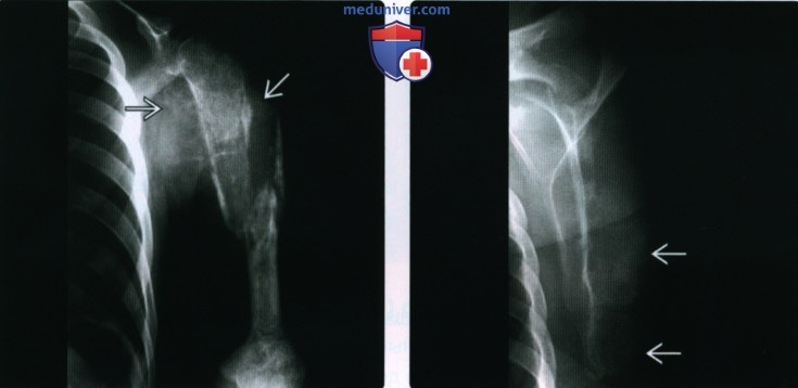 Рентгенограмма, МРТ изменений костей после лучевой терапии