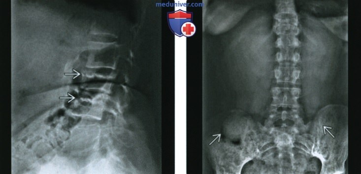 Рентгенограмма, МРТ костей при болезни Гоше