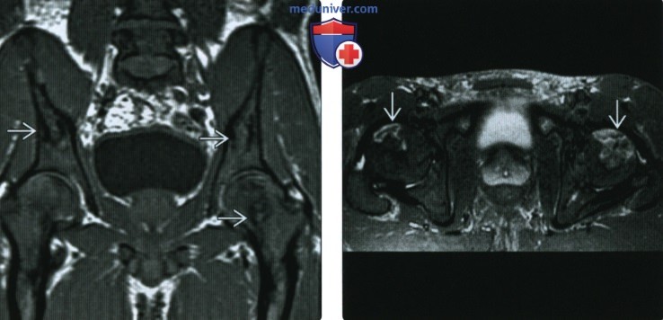 Рентгенограмма, МРТ костей при серповидноклеточной анемии