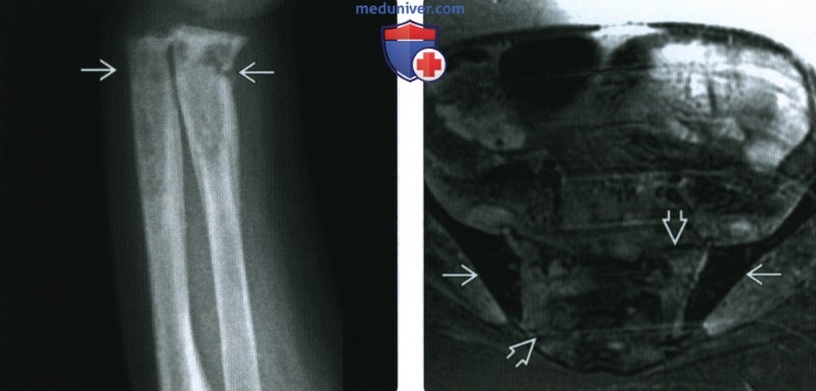Рентгенограмма, МРТ костей при серповидноклеточной анемии