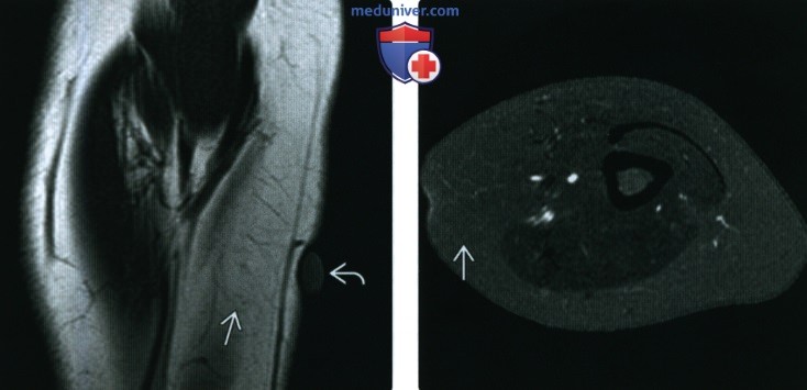 Рентгенограмма, МРТ при липоме мягких тканей