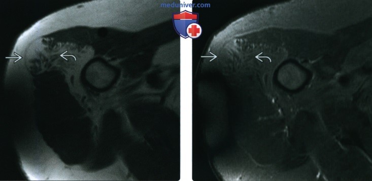 Рентгенограмма, МРТ при липоме мягких тканей