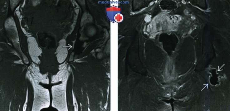 Рентгенограмма, МРТ при мелореостозе