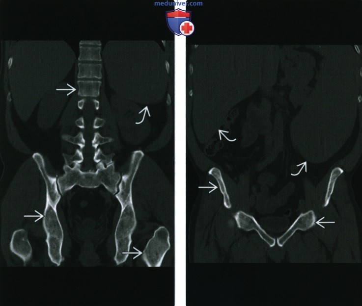 Рентгенограмма, МРТ при миелофиброзе