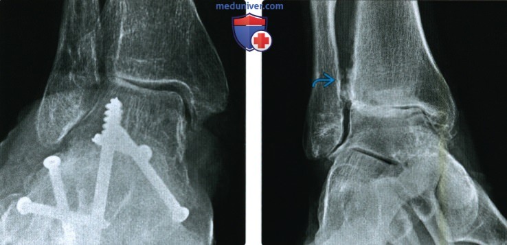 Рентгенограмма, МРТ при нестабильности голеностопного и подтаранного суставов