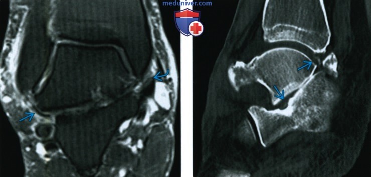 Рентгенограмма, МРТ при нестабильности голеностопного и подтаранного суставов