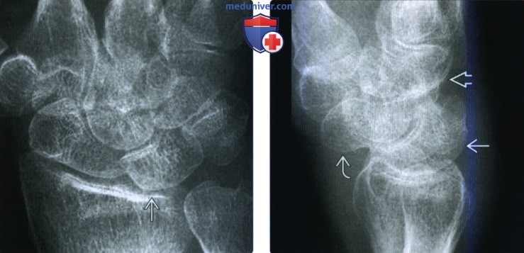 Рентгенограмма, МРТ при нестабильности запястья