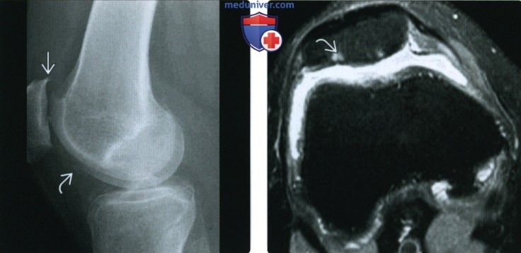 Рентгенограмма, МРТ при остеоартрозе коленного сустава