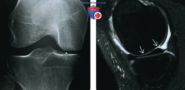 Рентгенограмма, МРТ при остеоартрозе коленного сустава