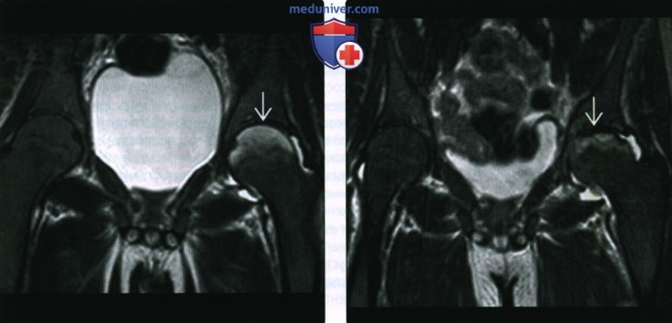 Рентгенограмма, МРТ при остеонекрозе бедренной кости