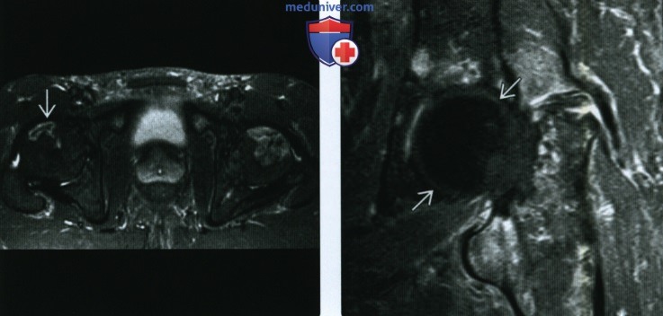 Рентгенограмма, МРТ при остеонекрозе бедренной кости