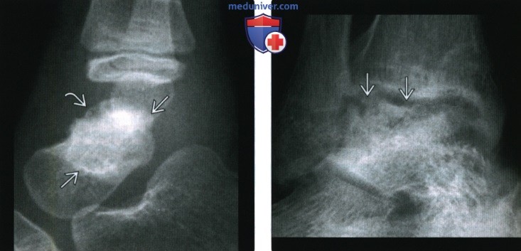 Рентгенограмма, МРТ при остеонекрозе голеностопного сустава и стопы