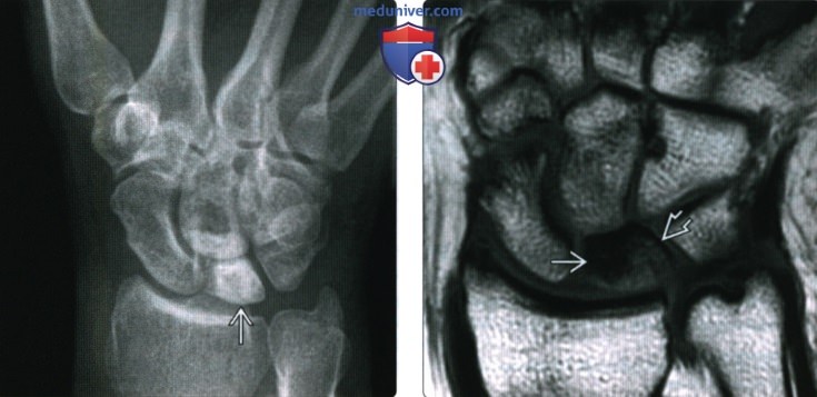 Рентгенограмма, МРТ при остеонекрозе лучезапястного сустава