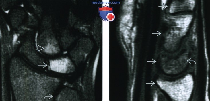 Рентгенограмма, МРТ при остеонекрозе лучезапястного сустава